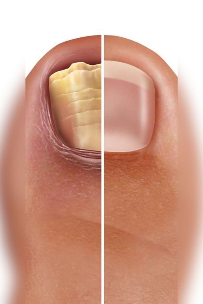 разница здорового ногтя от ногтя с грибком